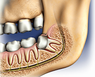 removing-wisdom-teeth-illustration-c517aa